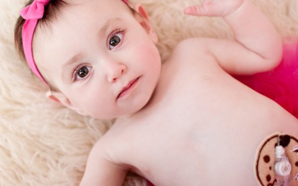 You're Not Poking a Hole in my Kid! From Refusal to begrudging Acceptance of a G Tube